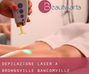 Depilazione laser a Brownsville-Bawcomville